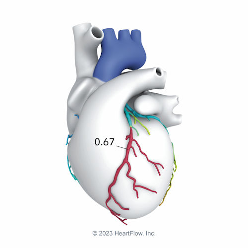 HeartFlow Analysis stylized heart