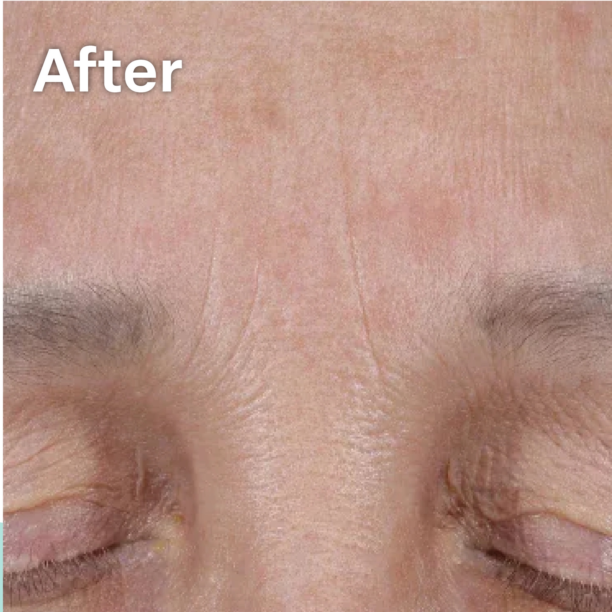 Elastiderm After