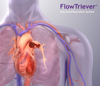 A New Treatment for Life-Threatening Pulmonary Embolism Is Available at Tanner